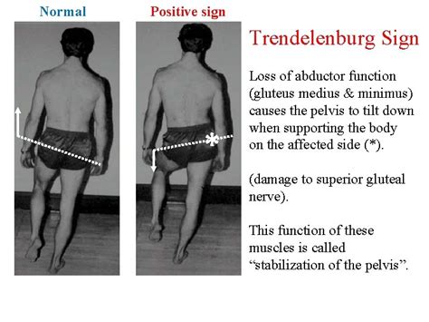 positive trendelenburg sign in child